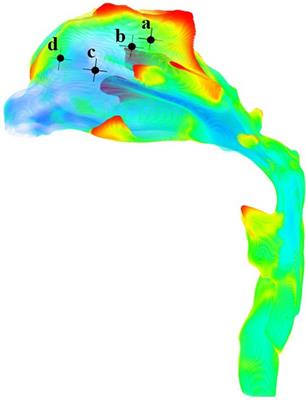 Numerical simulation of upper airway heat transfer in children with mandibular retrognathia during inspiratory process